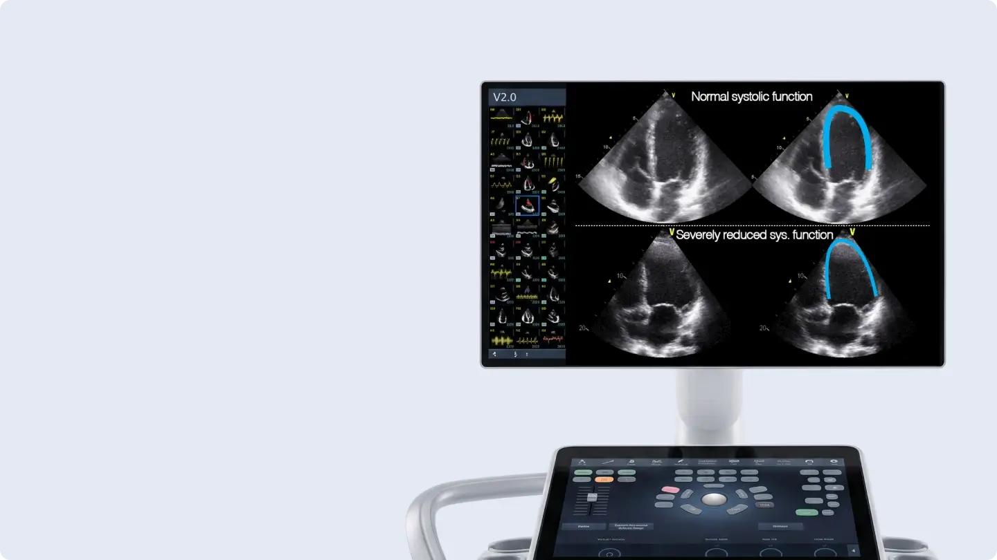 Echocardiography monitor comparing normal versus severely reduced left ventricular systolic function