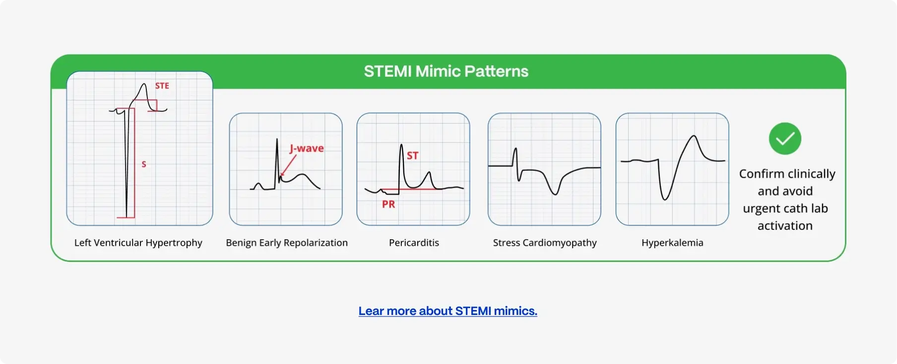 ECG waveforms of five STEMI mimics: LVH, benign early repolarization, pericarditis, stress cardiomyopathy and hyperkalemia