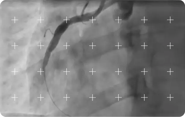 Coronary angiogram serving as angiography-based ground truth for model training