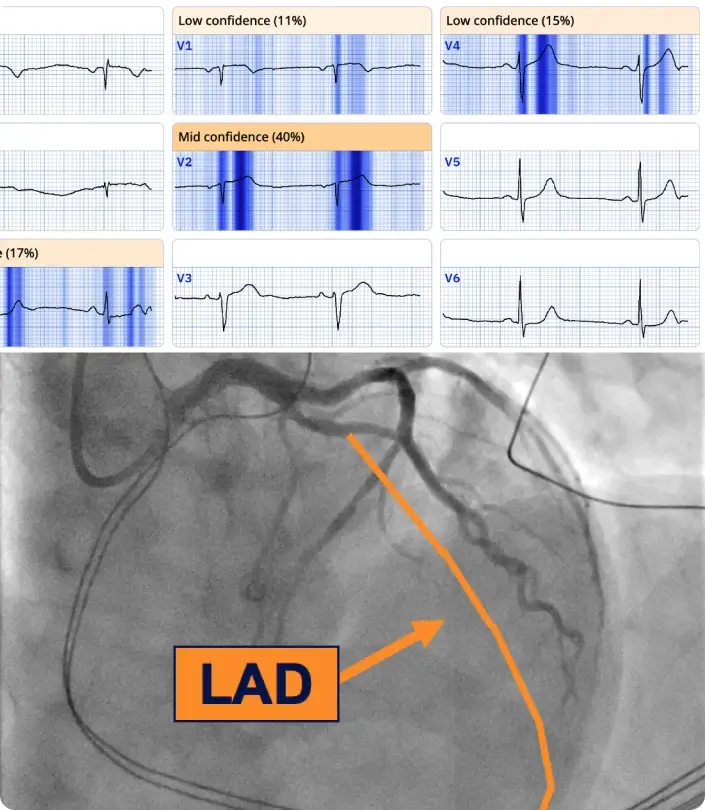 PMcardio ECG visualization with angiogram confirming LAD occlusion in a real case