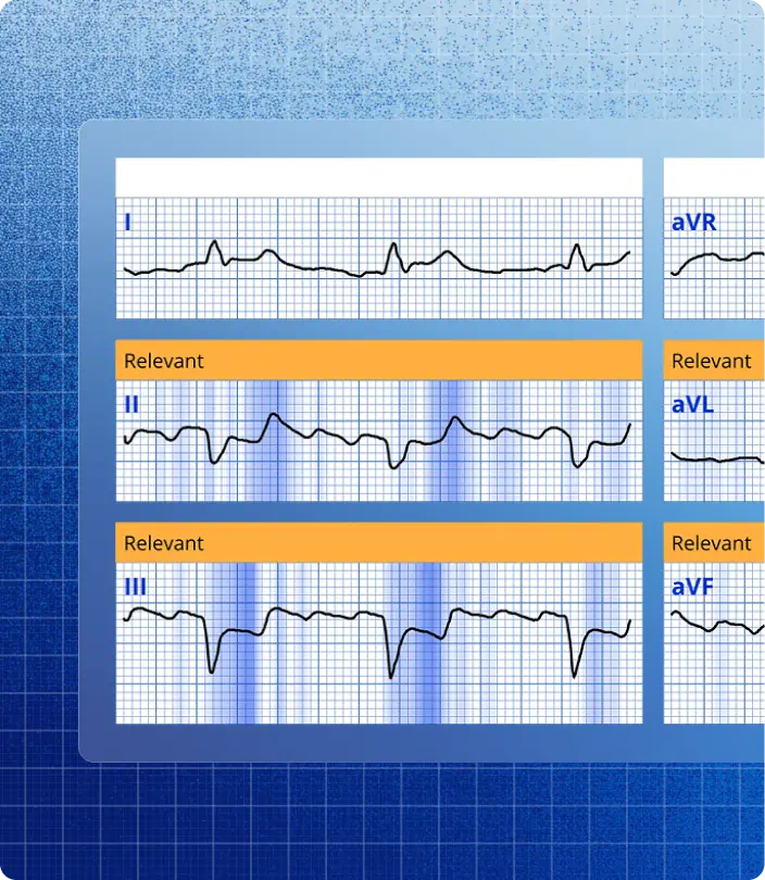 PMcardio ECG leads with ECGxplain highlighting the segments driving the AI prediction