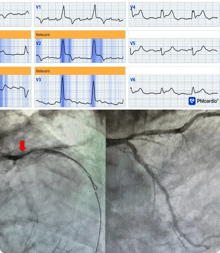 PMcardio ECG showing hyperacute T-waves with angiograms confirming coronary occlusion