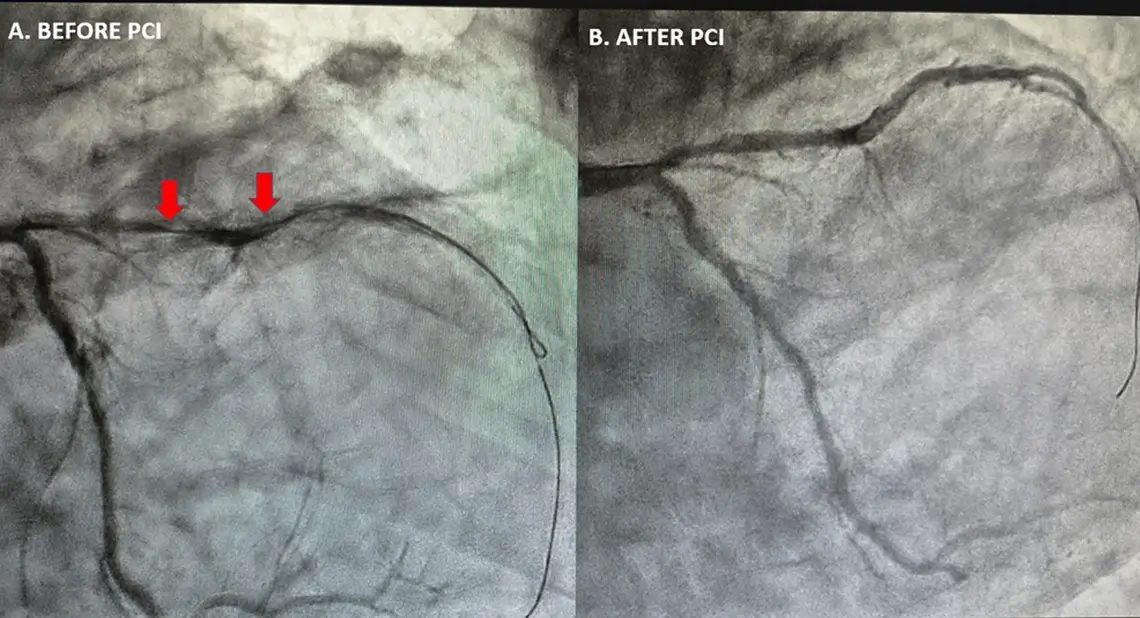Coronary angiography before and after PCI showing near-occlusive proximal LAD lesion restored by stenting
