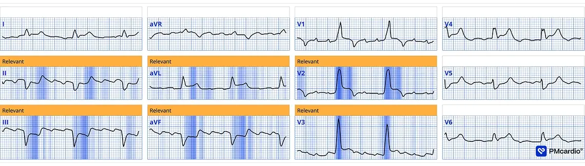 PMcardio Queen of Hearts AI ECG analysis flagging STEMI-equivalent ST changes in inferior and anterior leads