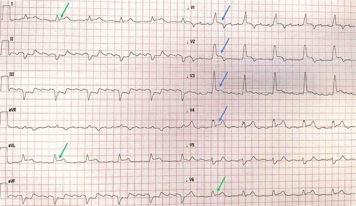 12-lead ECG showing bifascicular block with concordant ST elevation in anterior and lateral leads