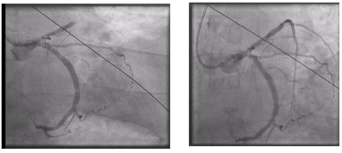Coronary angiogram showing proximal LAD occlusion before PCI and restored TIMI 3 flow after
