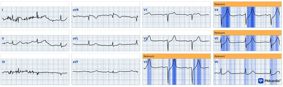 PMcardio Queen of Hearts ECG analysis flagging De Winter T-waves in leads V3-V6 as relevant