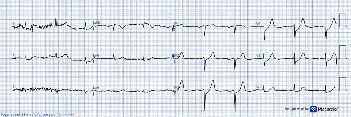 Prehospital 12-lead ECG showing precordial De Winter T-waves with poor R-wave progression from LAD occlusion