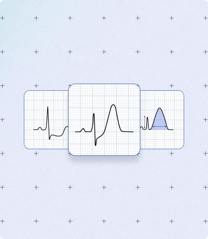 Three ECG tracings showing hyperacute T-waves, a STEMI-equivalent pattern