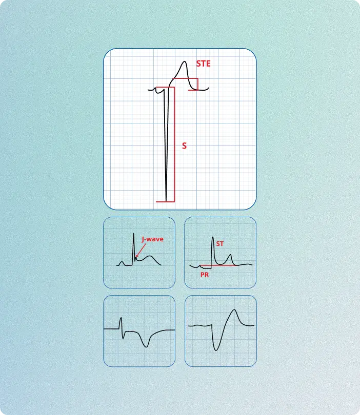 ECG diagrams contrasting true ST elevation with mimics like early repolarization and pericarditis