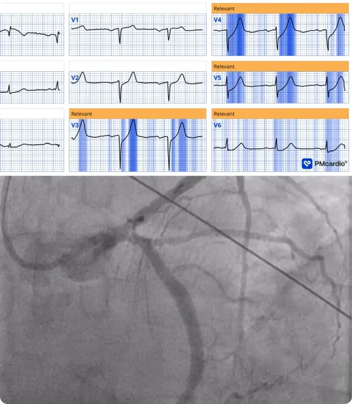 PMcardio ECG with ST elevation and coronary angiogram during catheter intervention