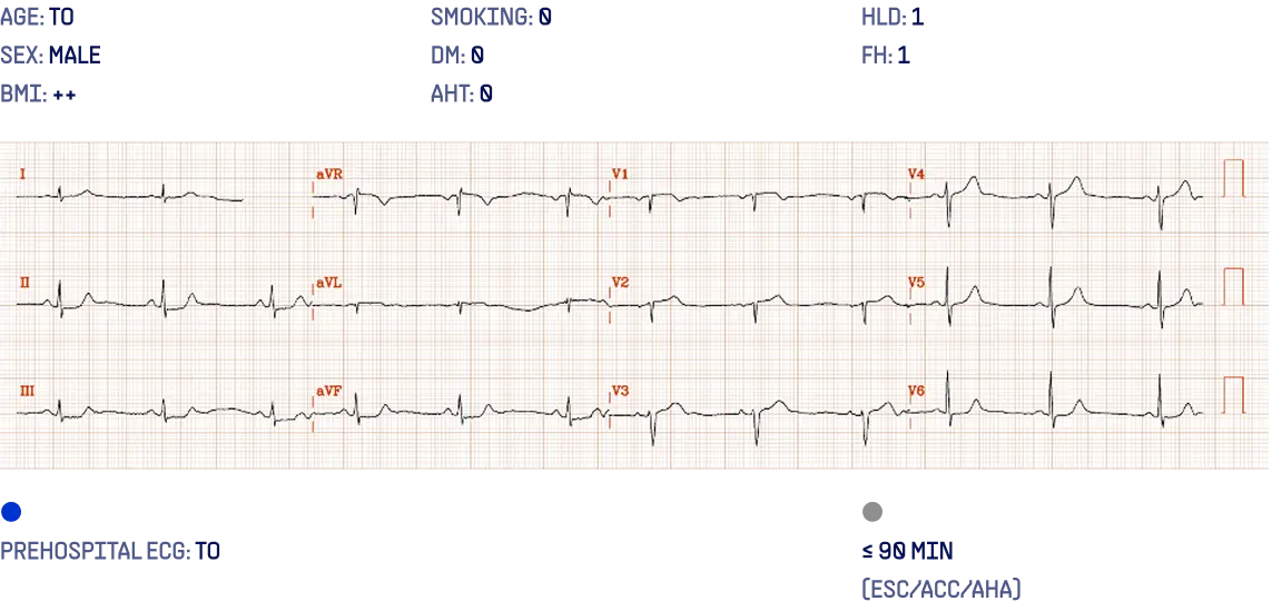 Prehospital 12-lead ECG of a 61-year-old man showing subtle anterior ischemic changes not meeting STEMI criteria