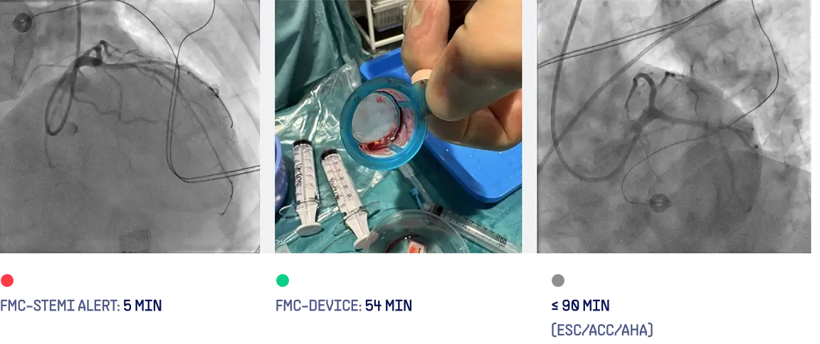 Post-PCI angiography after thrombus aspiration and stenting restoring TIMI-3 flow in the LAD
