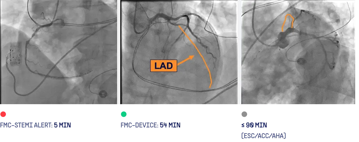 Coronary angiography showing acute mid-LAD occlusion with TIMI-0 flow, culprit vessel marked LAD