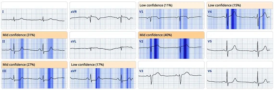Queen of Hearts AI explainability highlighting a precordial swirl pattern across precordial leads indicating LAD occlusion