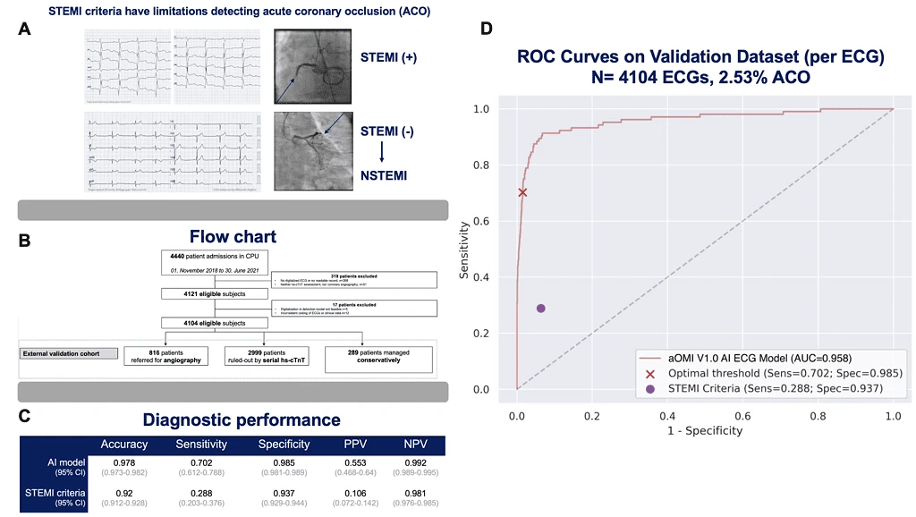Study figure with ECGs, flow chart, ROC curves and table comparing AI ECG model to STEMI criteria for acute coronary occlusion