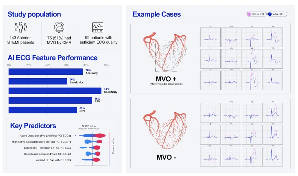 PMcardio AI ECG study visual abstract on detecting microvascular obstruction after anterior STEMI, 76% accuracy and 94% specificity