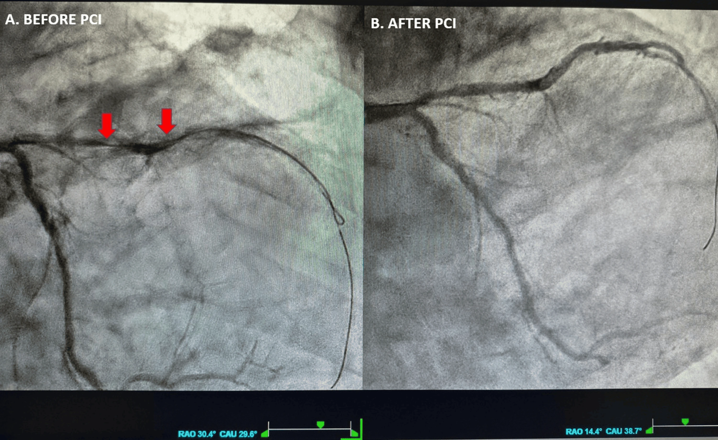Coronary angiography before and after PCI of a near-occlusive proximal LAD lesion, restoring TIMI 3 flow