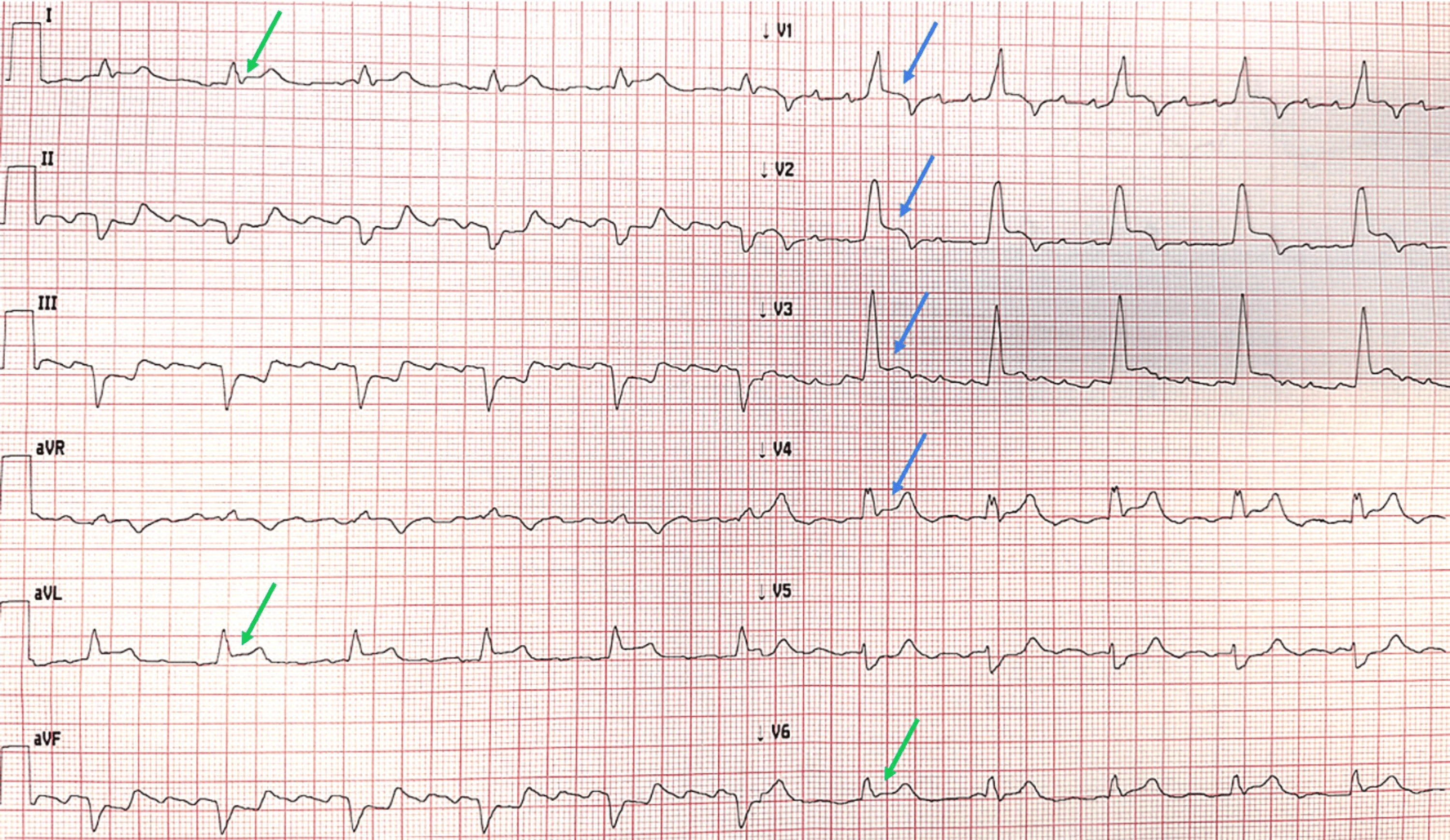 12-lead ECG with concordant ST elevation in V1-V4 and lateral ST elevation in I, aVL and V6 in anterolateral STEMI