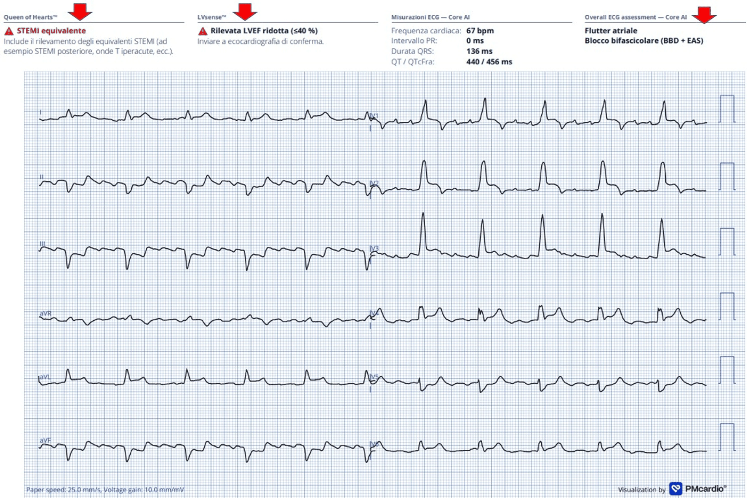 PMcardio Queen of Hearts ECG report flagging STEMI-equivalent, reduced LVEF, atrial flutter and bifascicular block