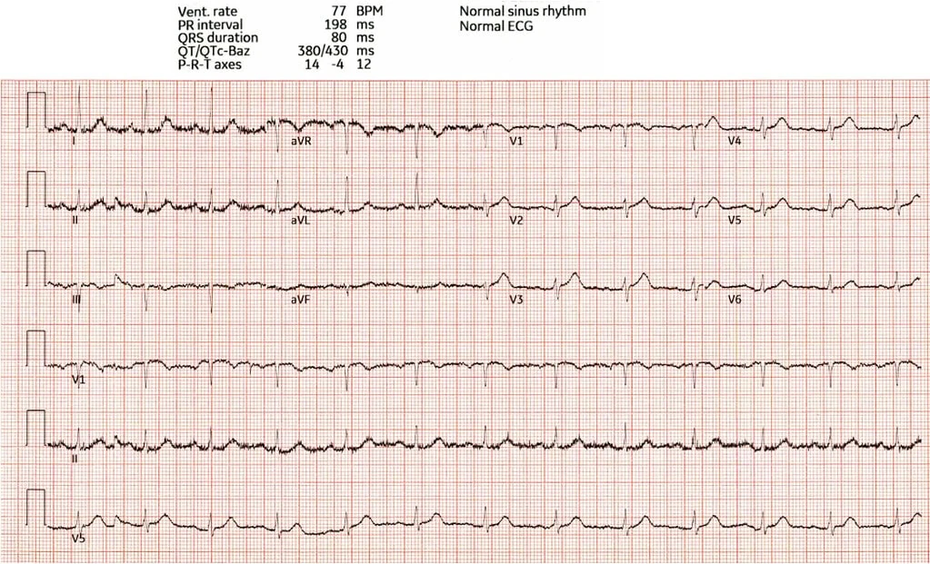 12-lead ECG machine-labeled normal sinus rhythm yet hiding subtle hyperacute T-waves in V2-V5 from acute LAD occlusion