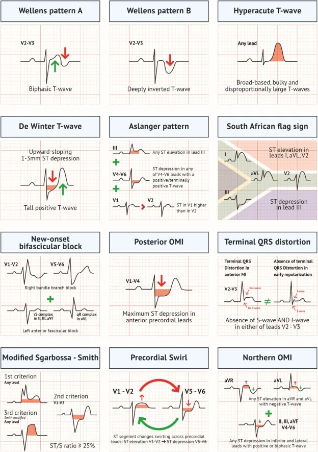 Chart of twelve ECG patterns of occlusion MI beyond STEMI criteria including Wellens, de Winter and Aslanger