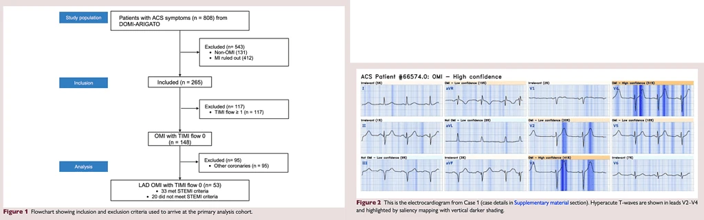 Study flowchart narrowing 808 patients to 53 LAD OMI cases beside PMcardio ECG flagging hyperacute T-waves in V2-V4