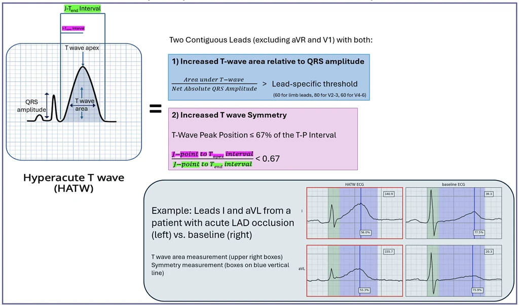 Hyperacute T-wave rule diagram with T-wave area to QRS ratio and symmetry criteria plus LAD occlusion ECG example in leads I and aVL