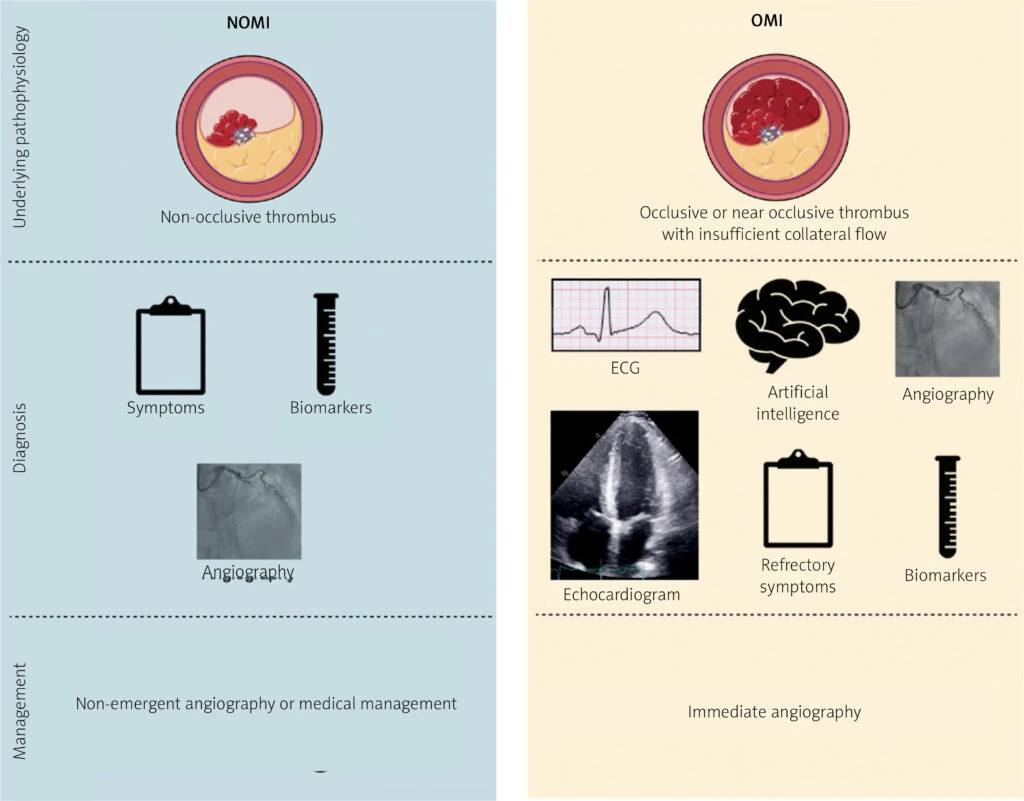 NOMI versus OMI comparison of thrombus pathophysiology, diagnostic tools, and management in acute coronary syndrome