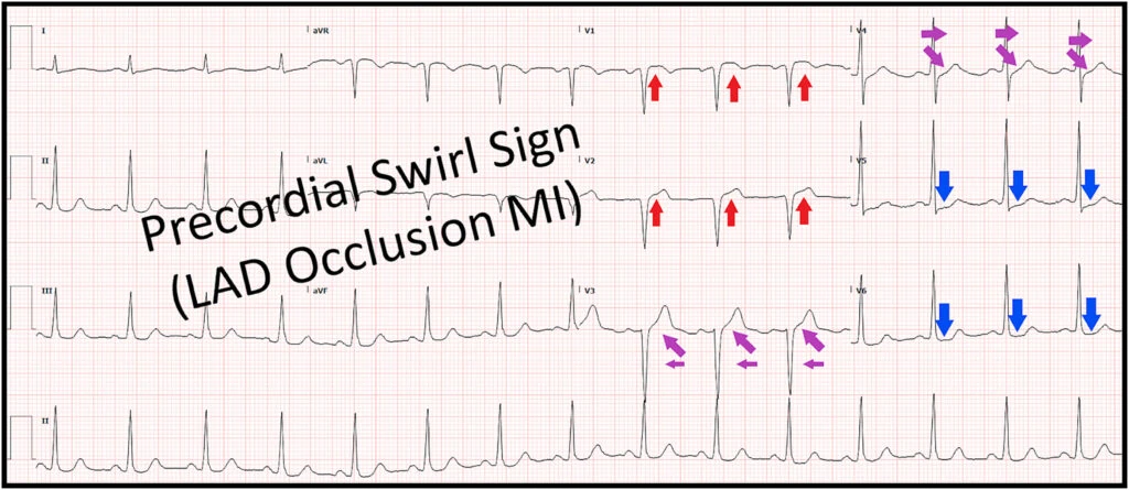 12-lead ECG showing precordial swirl sign, ST elevation in V1-V2 with reciprocal ST depression in V5-V6 from proximal LAD occlusion
