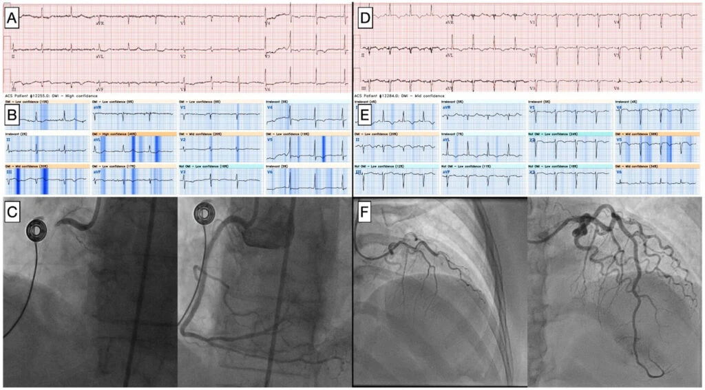 Six-panel figure of two OMI cases missed by cardiologists but flagged by PMcardio Queen of Hearts AI, confirmed by angiography