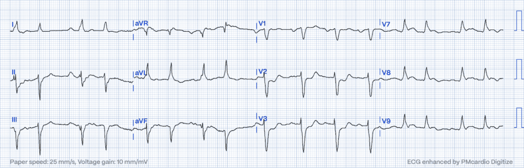 STEMI Equivalents:  Posterior MI