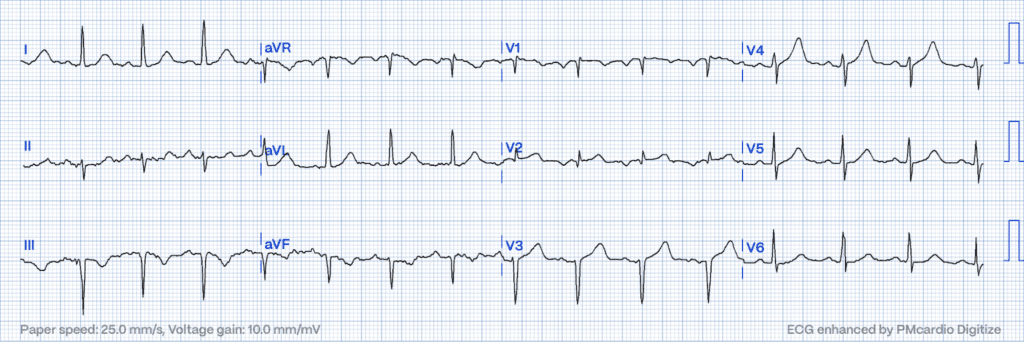 STEMI Equivalents:  Hyperacute T-waves in V4