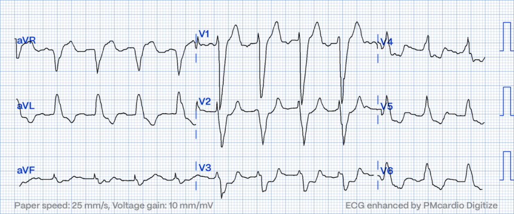 STEMI Equivalents:  concordant ST elevation in V2, proportionally excessively discordant STE in V3 and concordant ST depression in V6