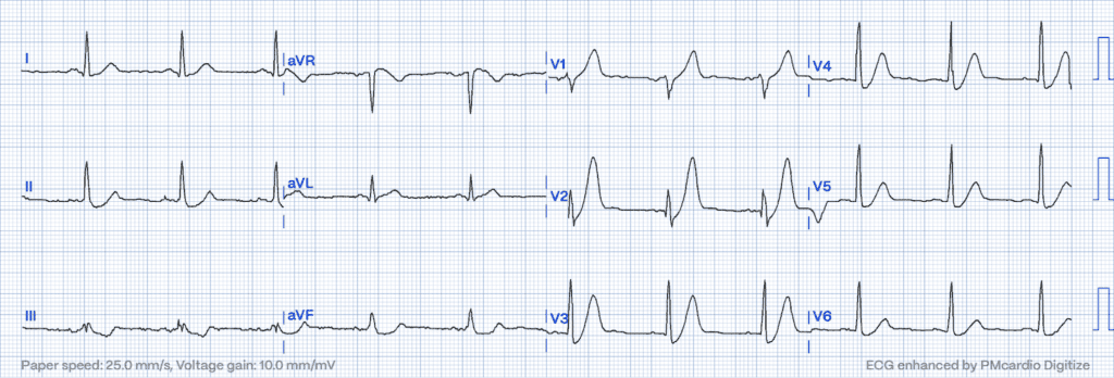 STEMI Equivalents: ECG - De Winter's T-waves 