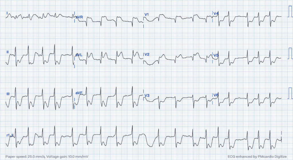  Posterior MI: ST Elevation in aVR 