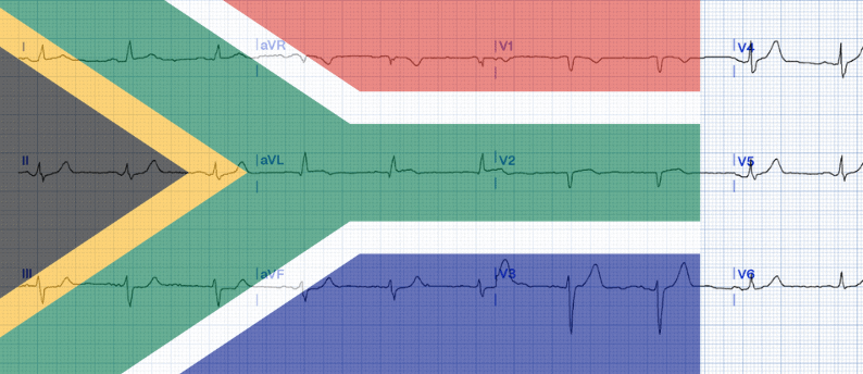 STEMI Equivalents: Navigating Hidden Indicators of Acute Coronary Occlusion