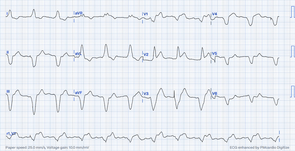 ECG - concordant ST elevation in V2, proportionally excessively discordant STE in V3 and concordant ST depression in V6 (Dr.Smith's  ECG Blog, digitized by PMcardio)