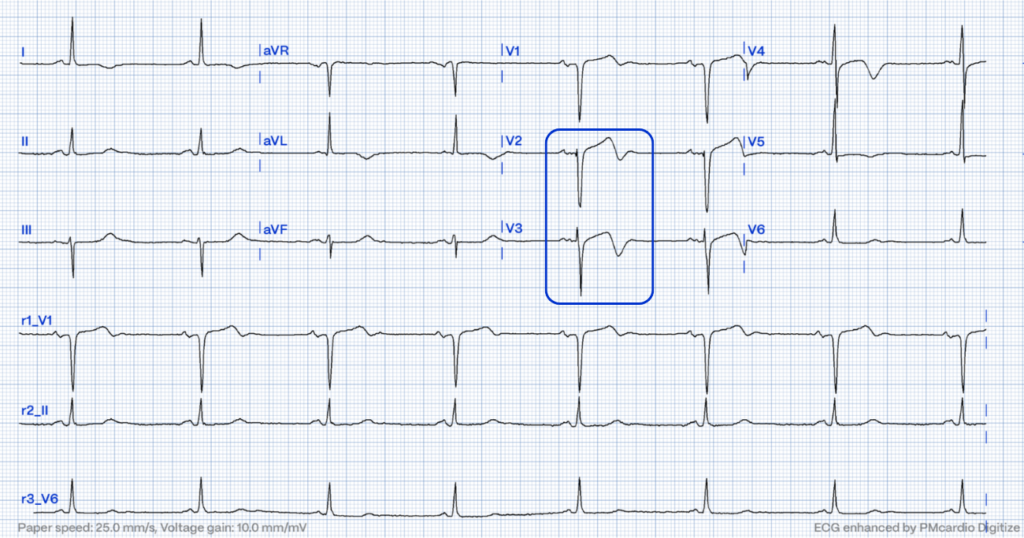 Wellens' syndrome ECG