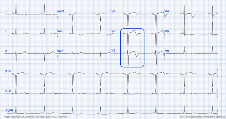 Wellens' Syndrome: How to Prevent Acute Coronary Occlusions