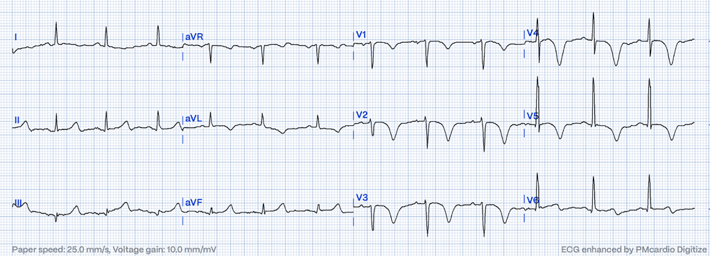 Wellens' Syndrome ECG type B