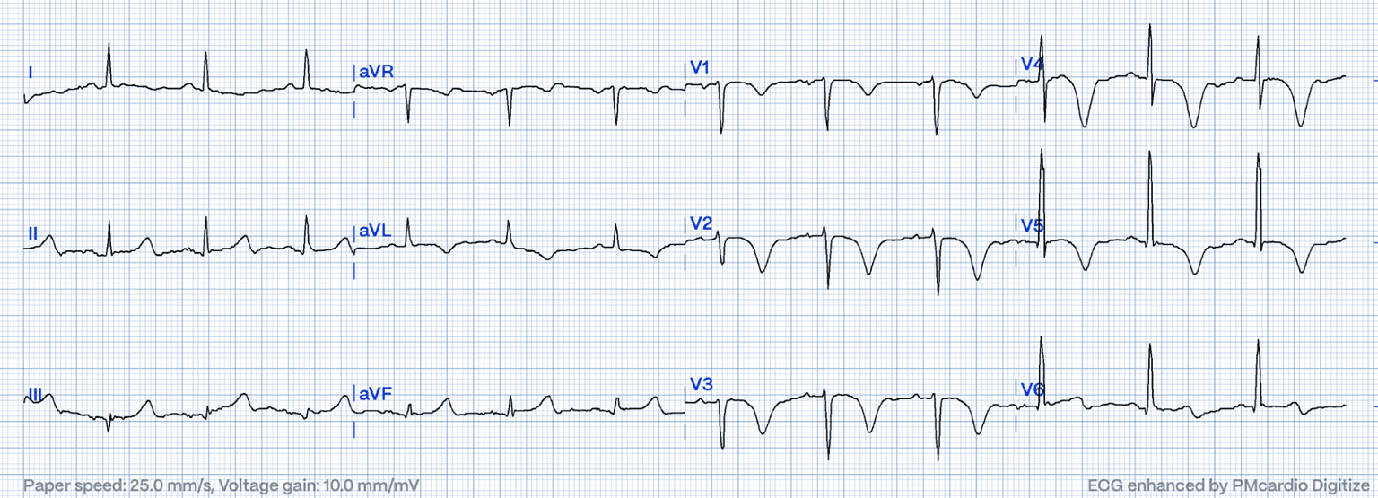 Wellens' Syndrome: How to Prevent Acute Coronary Occlusions