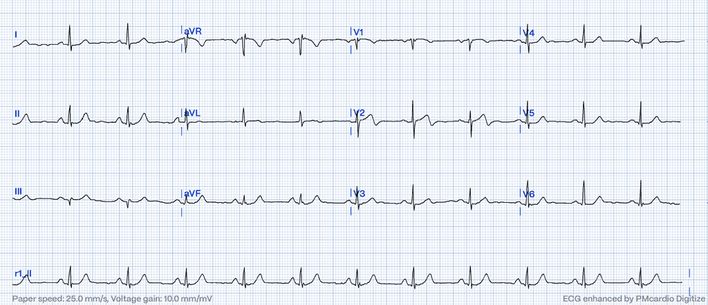 Wellens' Syndrome ECG Type A