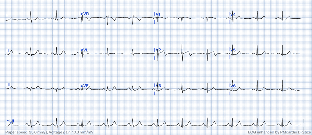 Wellens' syndrome ECG Type A