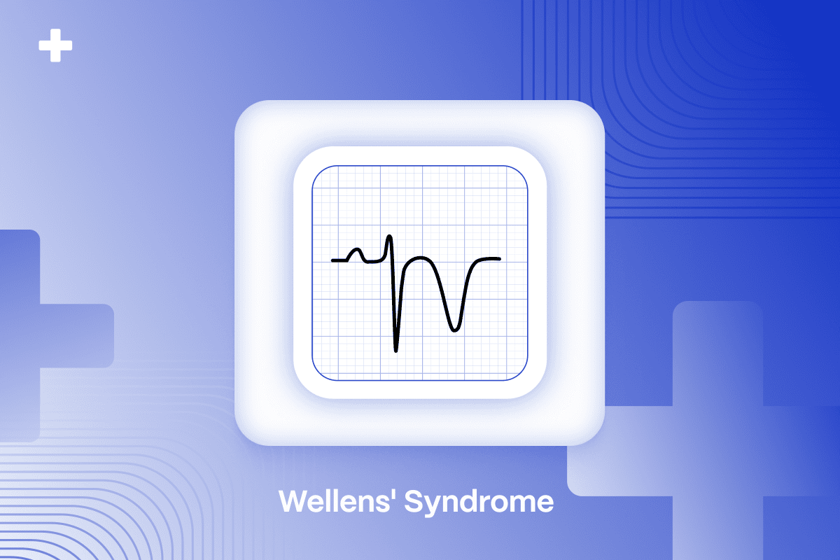 Wellens syndrom ECG - Blog