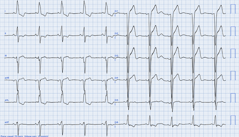 Left Ventricular Systolic Dysfunction (LVSD): The Basics and AI