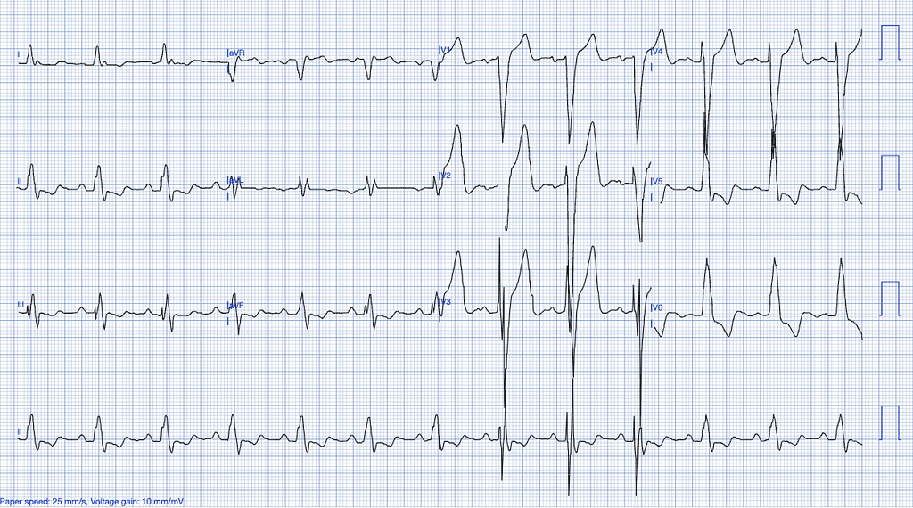 STEMI Mimics: Spot the Subtle Impostors of Myocardial Infarction STEMI Mimics ECG Features of Previously Diagnosed LBBB ECG