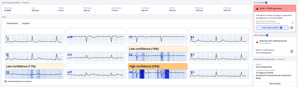 ECG Interpretation Tools Compared – Why PMcardio Stands Out ECG Interpretation Tools Compared – Why PMcardio Stands Out