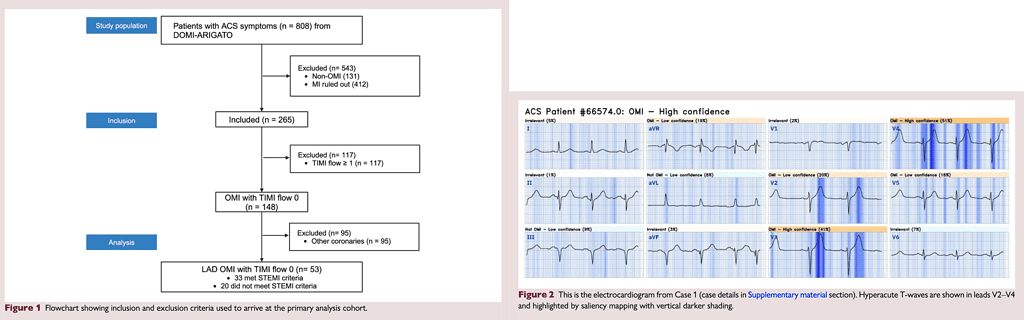 Failure of standard contemporary ST-elevation myocardial infarction electrocardiogram criteria to reliably identify acute occlusion of the left anterior descending coronary artery