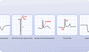 PMcardio STEMI AI ECG Model | Queen of Hearts
